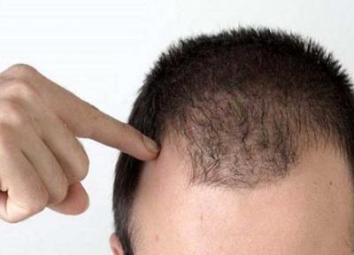 راههایی برای جلوگیری از ریزش مو در آقایان
