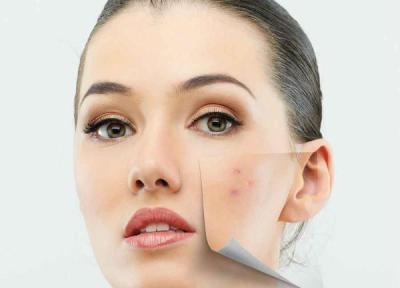 روش های خانگی فوق العاده موثر برای درمان آکنه و جوش صورت